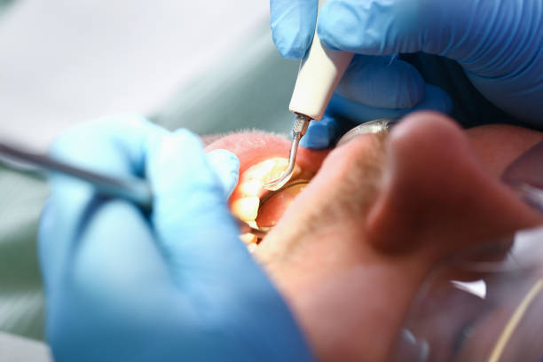 Best Emergency Tooth Extraction in Carney, MD