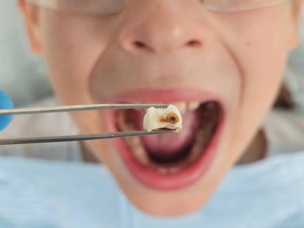 Best Emergency Treatment for Toothache in Carney, MD