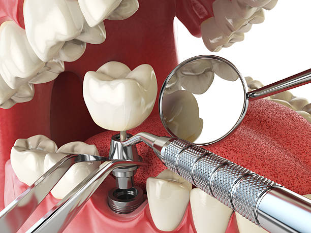 Best Emergency Tooth Extraction in Carney, MD